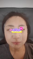 体验后-丰联丽格医疗美容·联合丽格眼整形中心