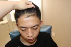 -大麦微针植发丨全国连锁