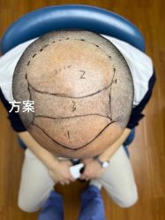 -大麦微针植发全国连锁