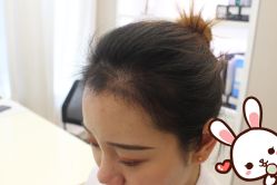 -大麦微针植发丨全国连锁