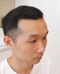 -大麦微针植发全国连锁