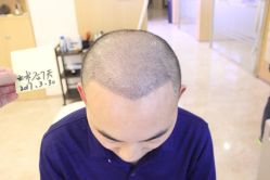 -大麦微针植发丨全国连锁