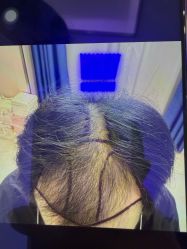 -碧莲盛·不剃发植发