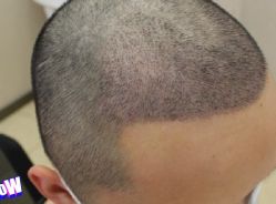 -大麦微针植发丨全国连锁