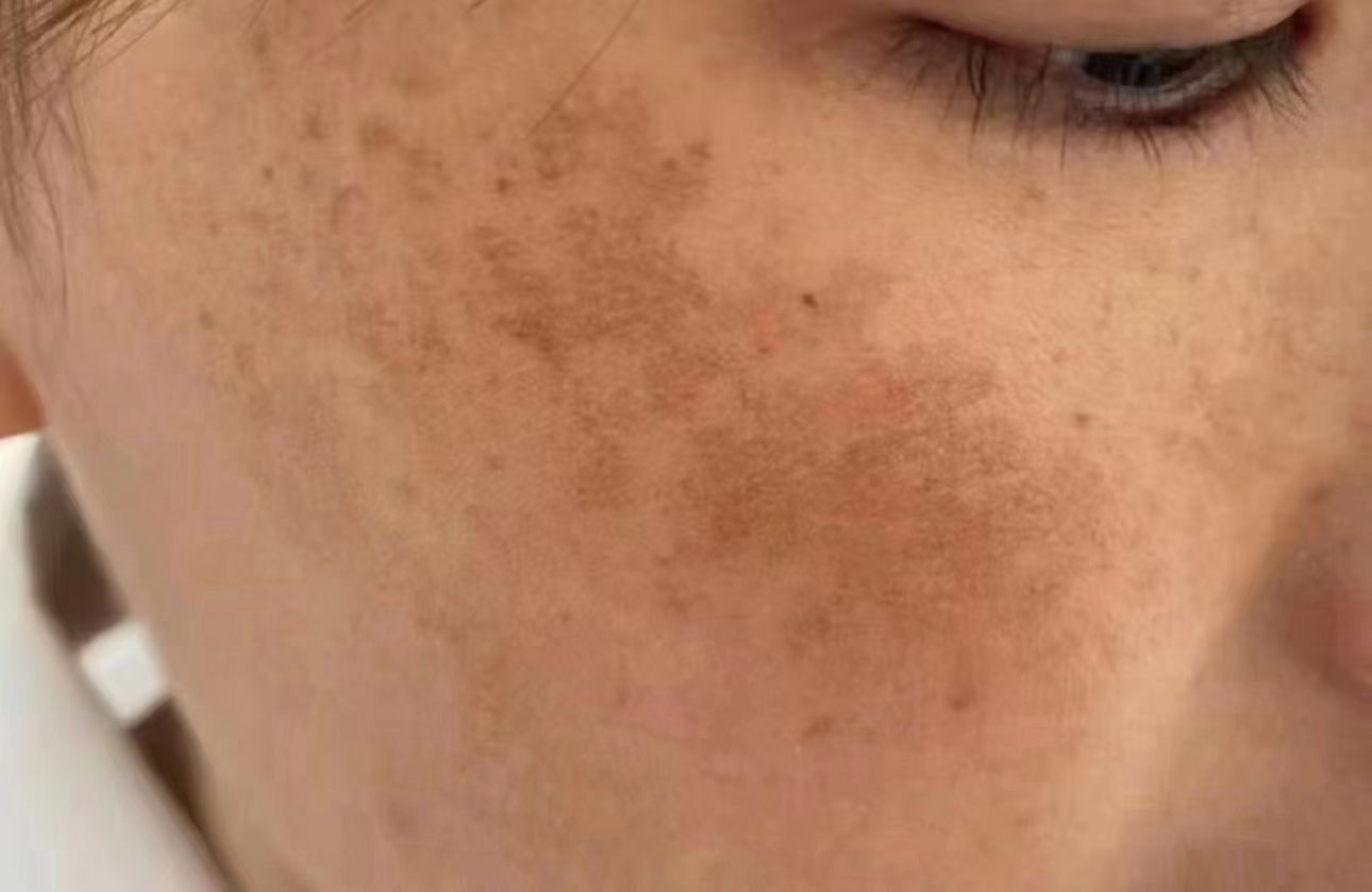 长斑时间久了,脸上容易出现混合斑,也就是