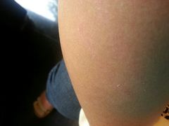 被该店领位员隔着厚厚的运动服抓出来的抓痕-御花园·粤菜·海鲜火锅(中山公园店)