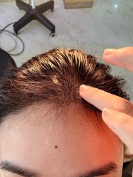 -大麦微针植发丨全国连锁
