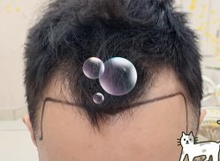 -大麦微针植发全国连锁