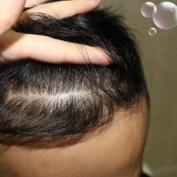 -大麦微针植发丨全国连锁