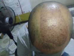 -碧莲盛·不剃发植发