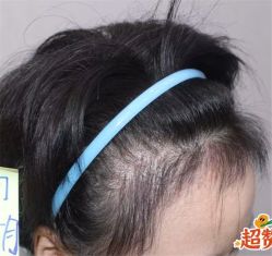 -大麦微针植发全国连锁