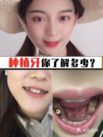 一周通知拆线，一个月复查，三个月装牙齿…