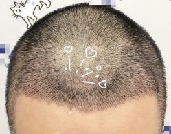 -大麦微针植发全国连锁