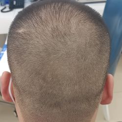 点击看大图 -大麦微针植发丨全国连锁