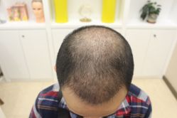 -大麦微针植发丨全国连锁