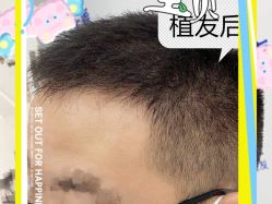 -大麦微针植发全国连锁