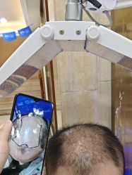 -碧莲盛·不剃发植发