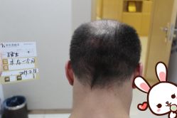 点击看大图 -大麦微针植发丨全国连锁