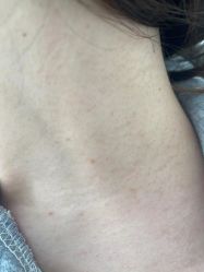 体验前-爱莎扁平疣·汗管瘤·斑痣中心