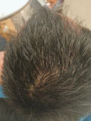 点击看大图 -碧莲盛·不剃发植发