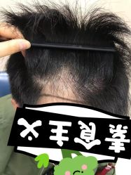 -大麦微针植发丨全国连锁