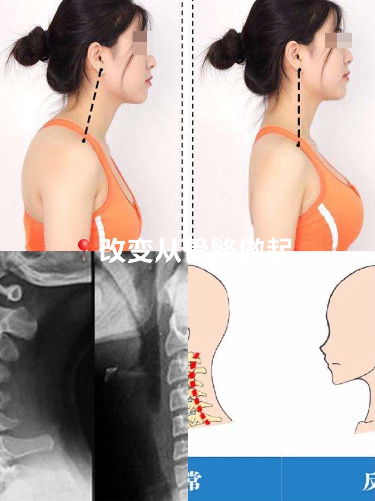 颈椎曲度变直的危害