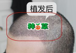 -大麦微针植发全国连锁