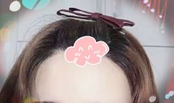 -大麦微针植发全国连锁