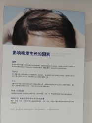 -碧莲盛不剃发植发