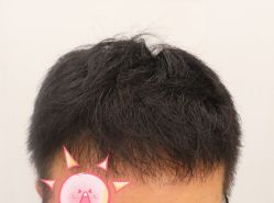 -大麦微针植发全国连锁