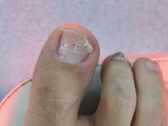 -新甲连锁灰指甲·甲沟炎·鸡眼(黑龙江路店)