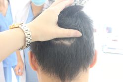 点击看大图 -大麦微针植发丨全国连锁