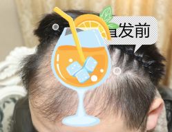 -大麦微针植发全国连锁