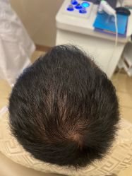 -大麦微针植发全国连锁