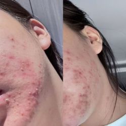 -瑶芳清颜草本祛痘