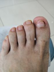 -派恩宜灰指甲鸡眼嵌甲手足癣