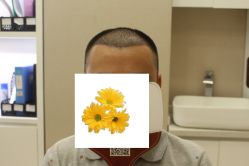 -大麦微针植发丨全国连锁
