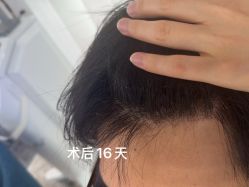 -北京雍禾植发医院