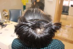 -大麦微针植发丨全国连锁