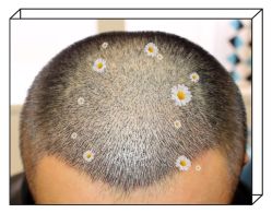 -大麦微针植发全国连锁