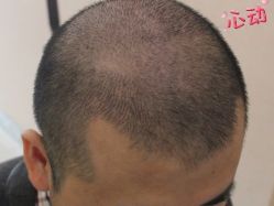 -大麦微针植发丨全国连锁