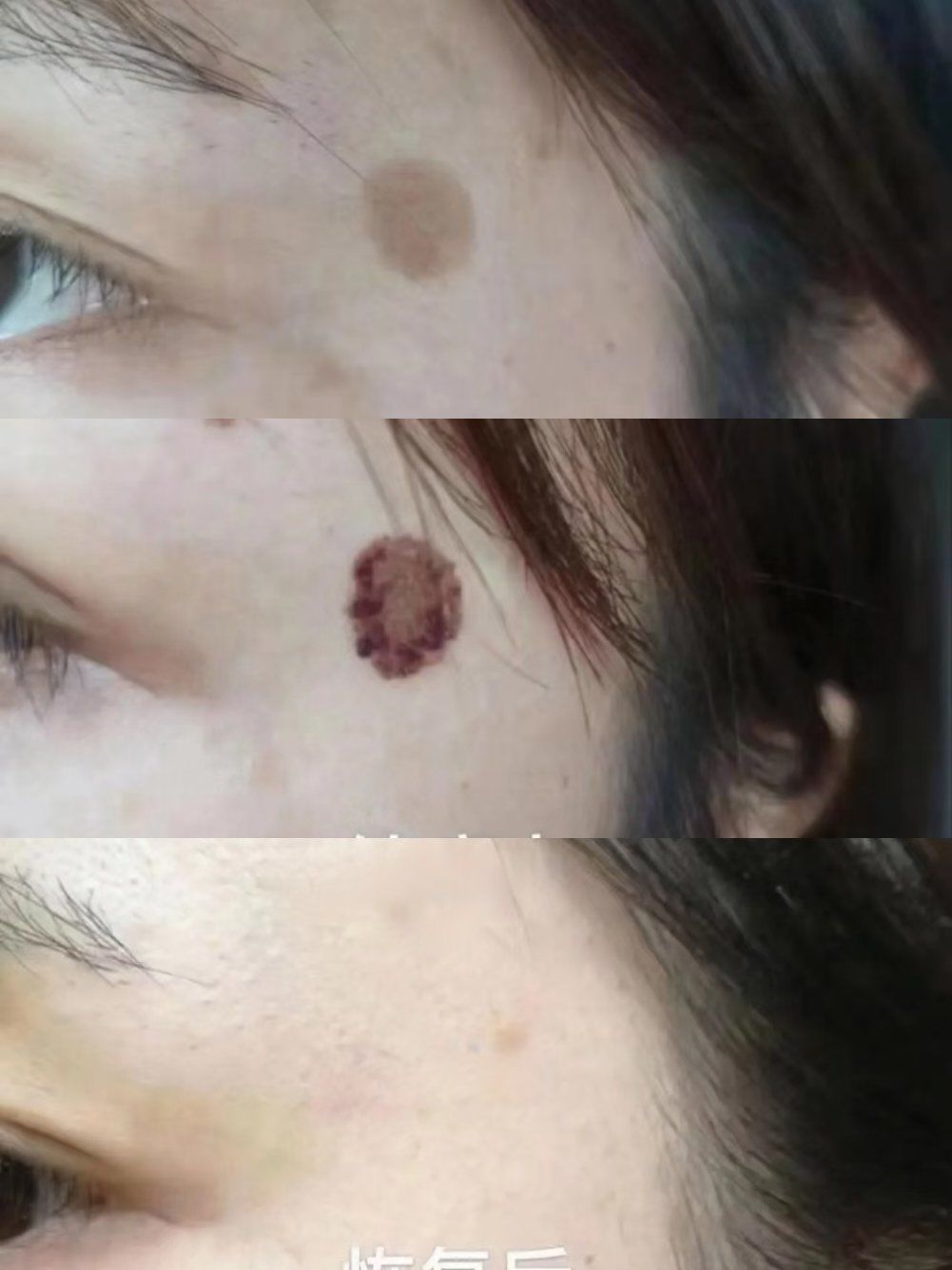 角‮老质‬化症 又称为"老年斑"