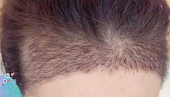 -大麦微针植发丨全国连锁