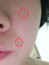 祛痘恢复后的暗色疤点-清颜堂丨分子祛痘·功效美肤