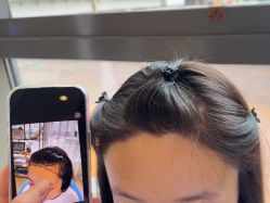 -碧莲盛·不剃发植发