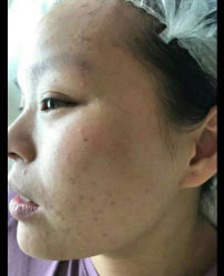 -爱莎扁平疣·汗管瘤·斑痣中心