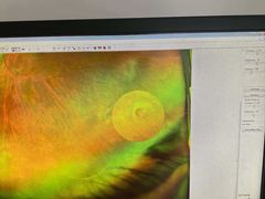 -成都新视界眼科医院·近视手术·儿童近视