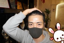 点击看大图 -大麦微针植发丨全国连锁