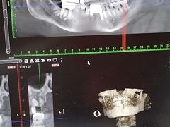 -上海仁爱医院口腔科 · 种植