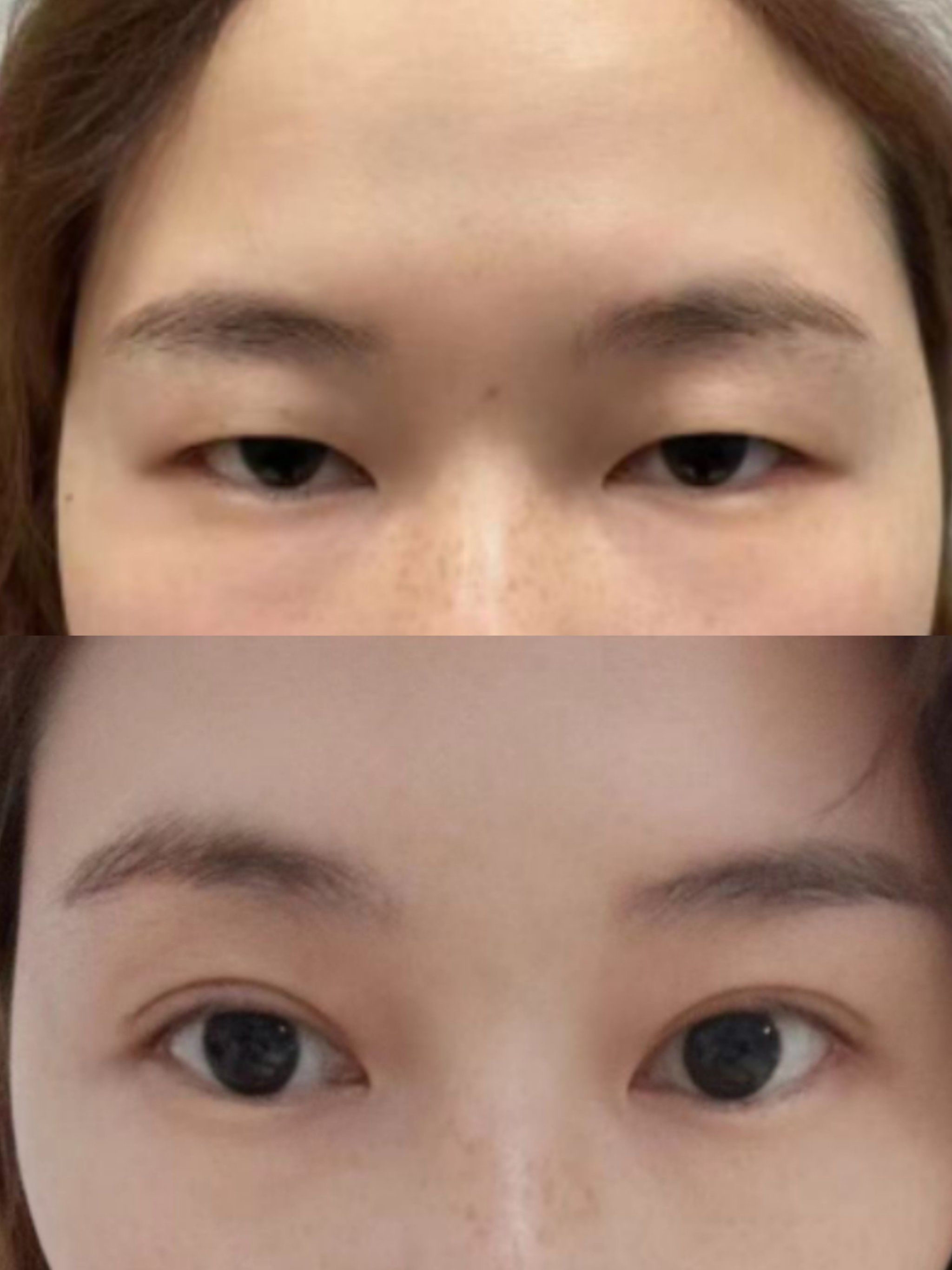 割双眼皮前后对比